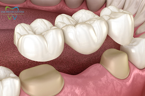 پل دندانی یا بریج دندان